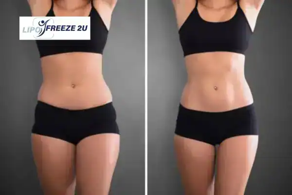How Can LIPO FREEZE 2U Support Your Post-Pregnancy Body Recovery East Kilbride?
