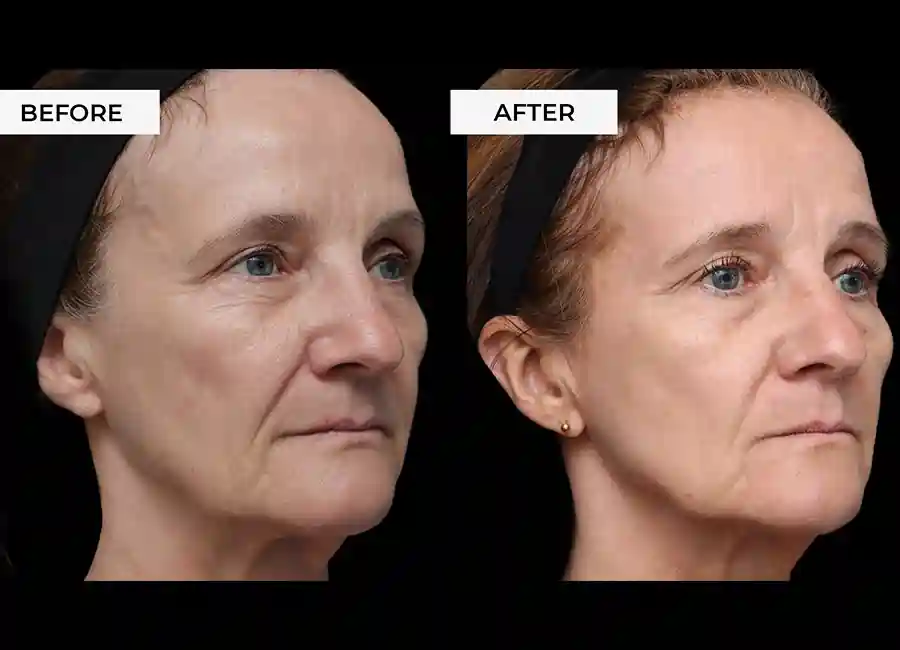 How Many RF Microneedling Sessions Will You Need to See a Difference East Kilbride?