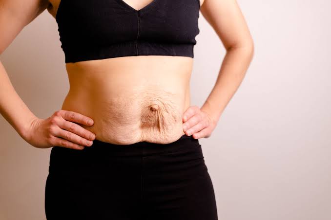 Is Surgery Really the Only Way to Repair Diastasis Recti East Kilbride?