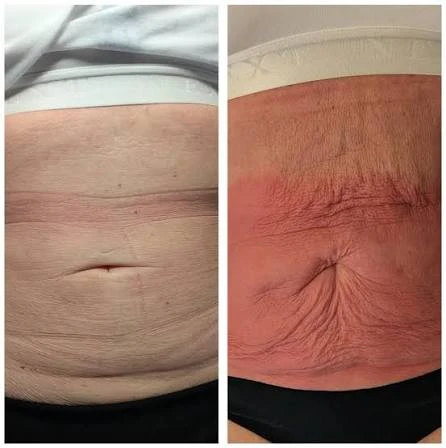 How Does RF Microneedling Improve Crepey, Thin and Uneven Skin Texture East Kilbride?