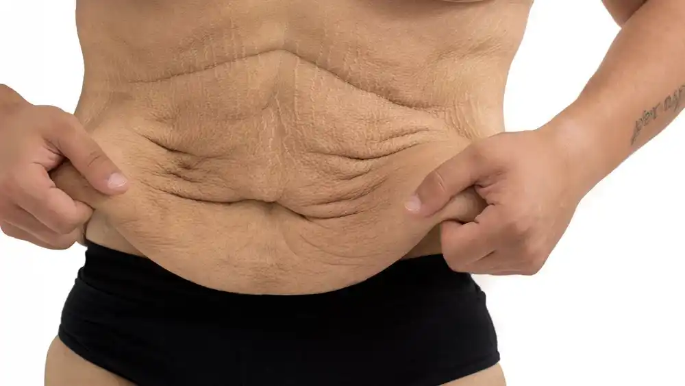 RF Microneedling for Loose Skin: How Can It Help Tighten and Reshape the Skin East Kilbride?